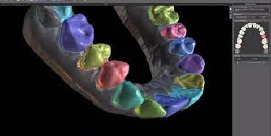 Aligner Treatment