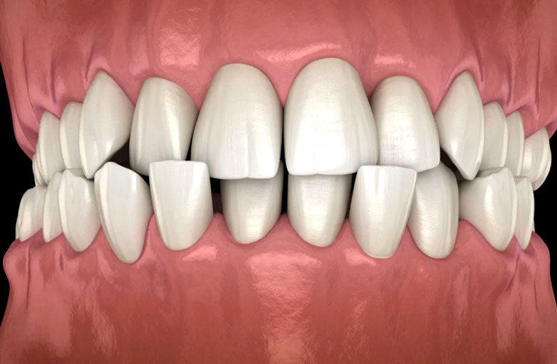Cross-Bite