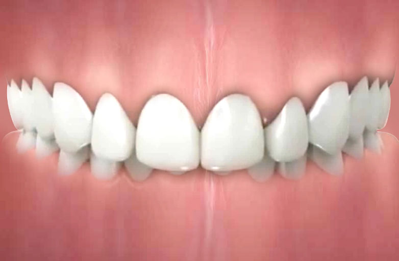 Deep-Bite