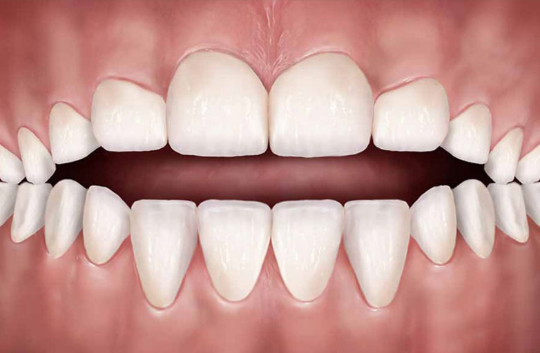 Open-Bite